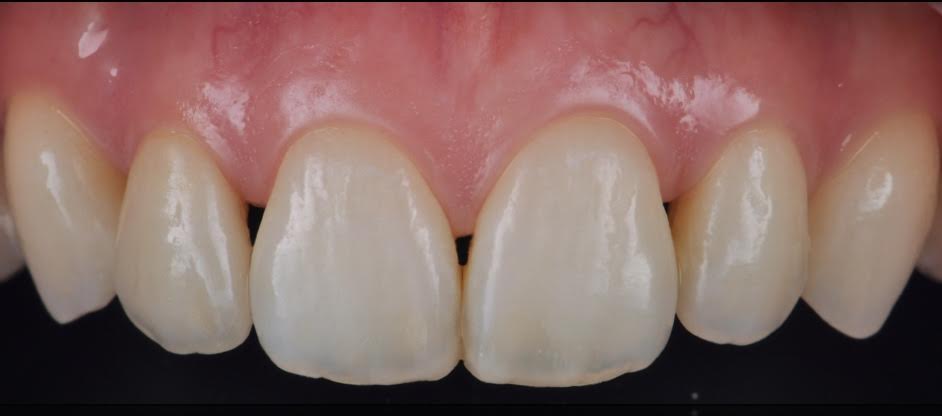 Case-4 After