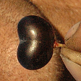 Le grain de raisin réniforme