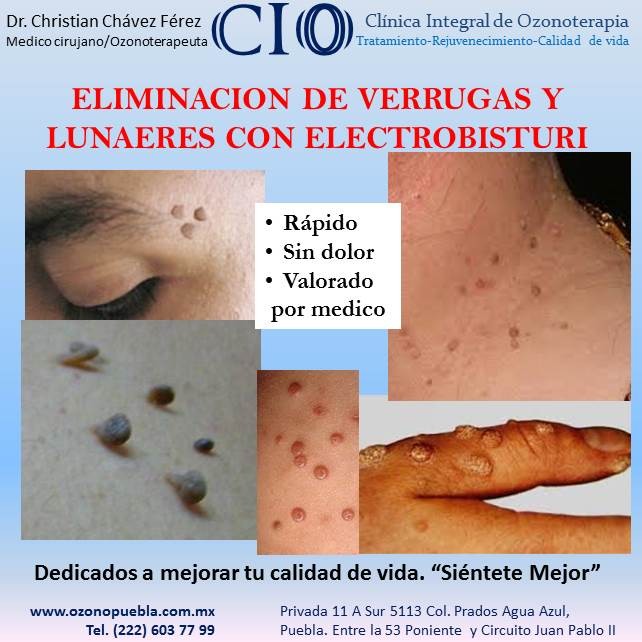 tratamiento para las verrugas en la cara