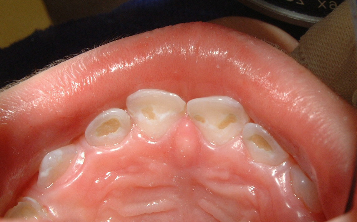 Karieshotpots Lieblingsstellen der Karies - schnelles Webseite!