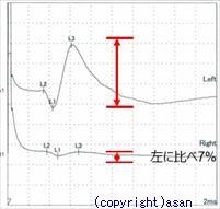 筋電図の検査　予後の予測