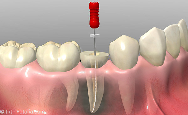 Was ist eine Wurzelbehandlung und wann muss sie gemacht werden?