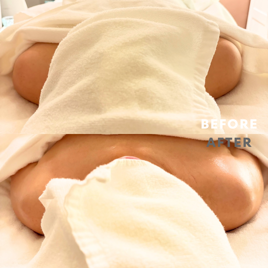 巻き肩リンパマッサージモニター③様