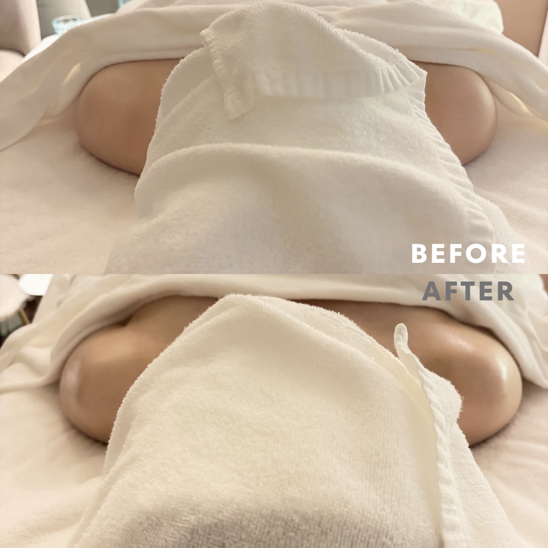 巻き肩リンパマッサージモニター⑨様