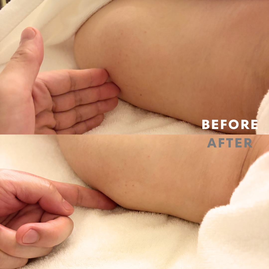 巻き肩リンパマッサージモニター③様