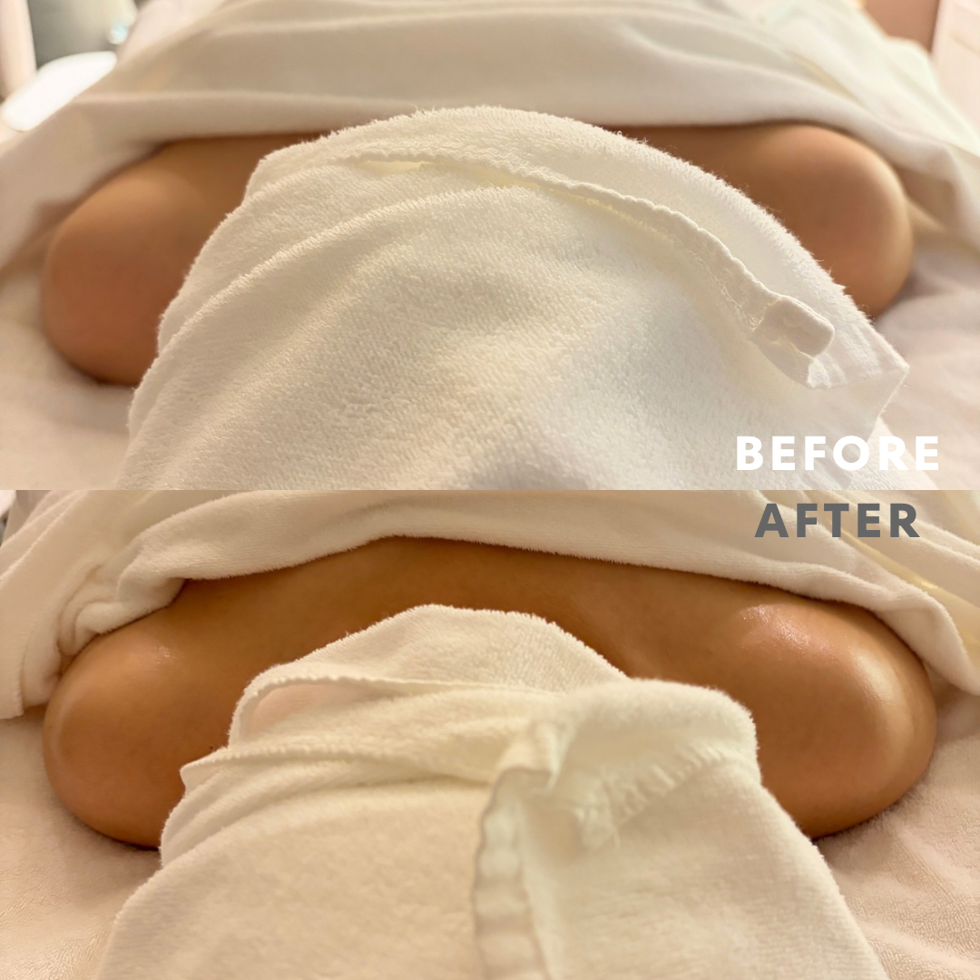 巻き肩リンパマッサージモニター①様