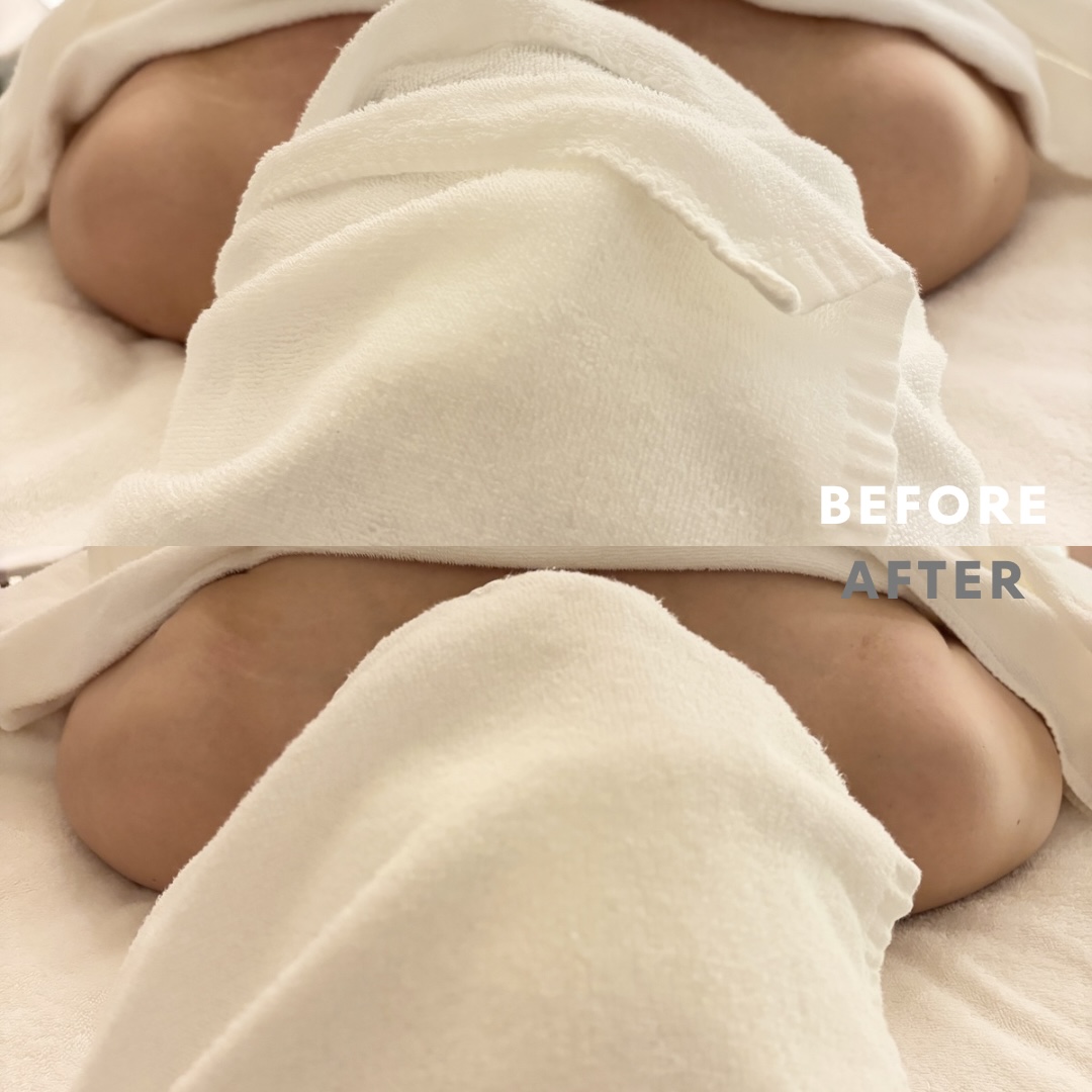 巻き肩リンパマッサージモニター④様