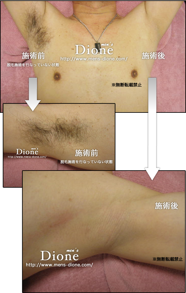 男性脱毛 大阪口コミ人気メンズ脱毛サロン メンズディオーネ大阪梅田店で男性脱毛におすすめの男vio脱毛 陰部 男胸毛脱毛を体験 大阪梅田 メンズ脱毛大阪口コミ人気メンズディオーネ大阪梅田でvio脱毛を男性が体験 男性脱毛 大阪口コミ人気メンズ脱毛サロン メンズディオーネ大阪梅田店で男性脱毛におすすめの男vio脱毛 陰部 男胸毛脱毛を体験 大阪梅田 メンズ脱毛大阪口コミ人気メンズディオーネ大阪梅田でvio脱毛を男性が体験