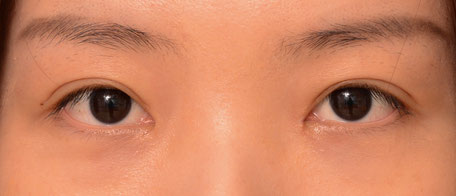 Patient with infold creation and medium fold height creation resulting in a natural appearing double eyelid surgery crease