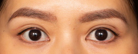 Patient with high folds placement and outfold double eyelid surgery crease. These results can look natural and distinct in those with a sunken or enotphalmic eye position