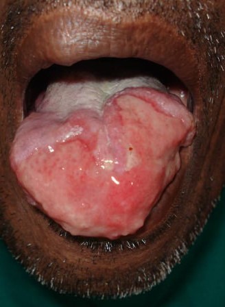 Lesioni alle mucose buccali in una persona affetta da leishmaniosi.