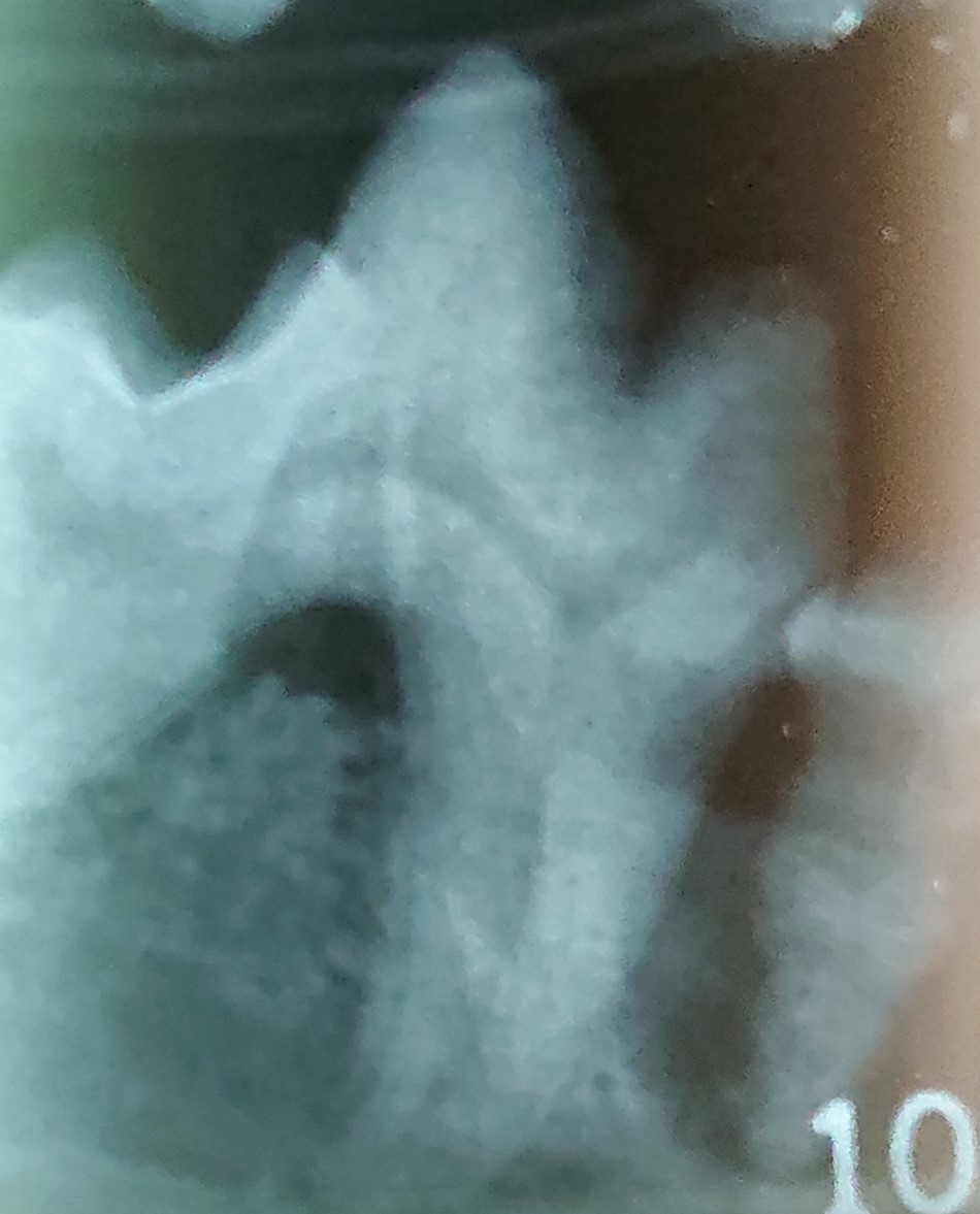 下奥歯のレントゲン検査