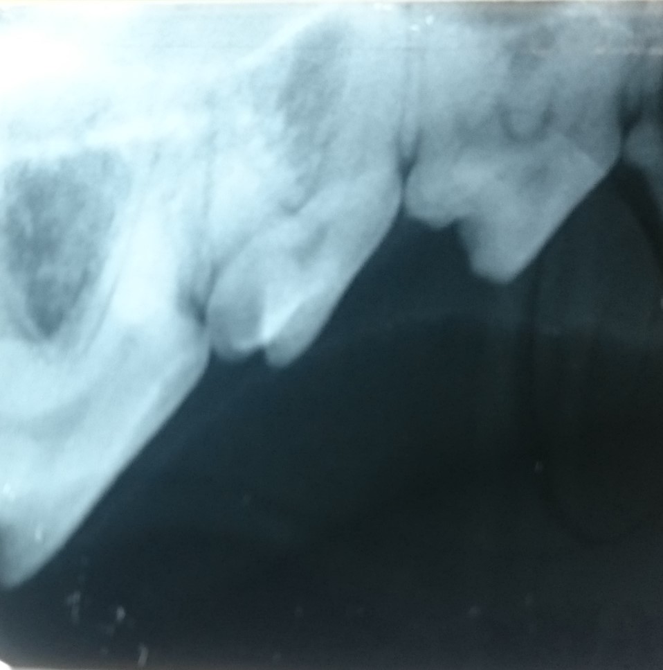 念のため右上嚙み合わせ臼歯のレントゲン検査・評価をしましたが右下臼歯のみの治療になりました。