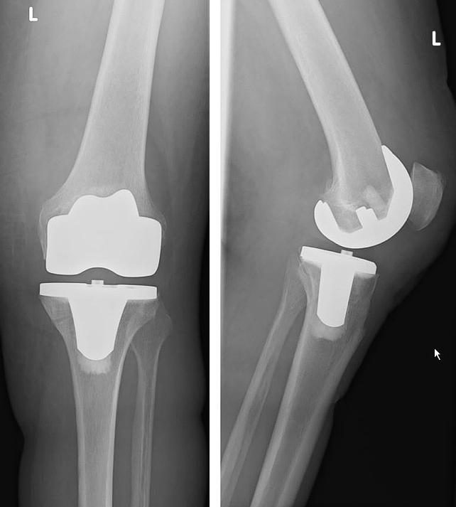 Knieprothese - Ihr Prothesenspezialist der Sportchirurgie in der ATOS Klinik Heidelberg