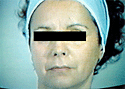 Radiofrecuencia facial