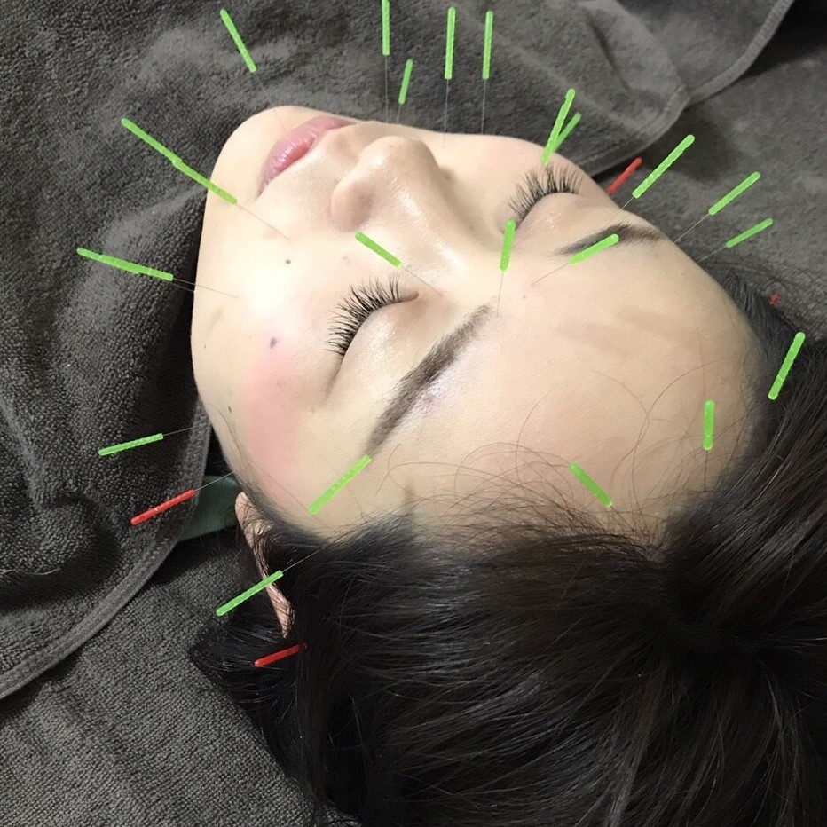 顔鍼治療