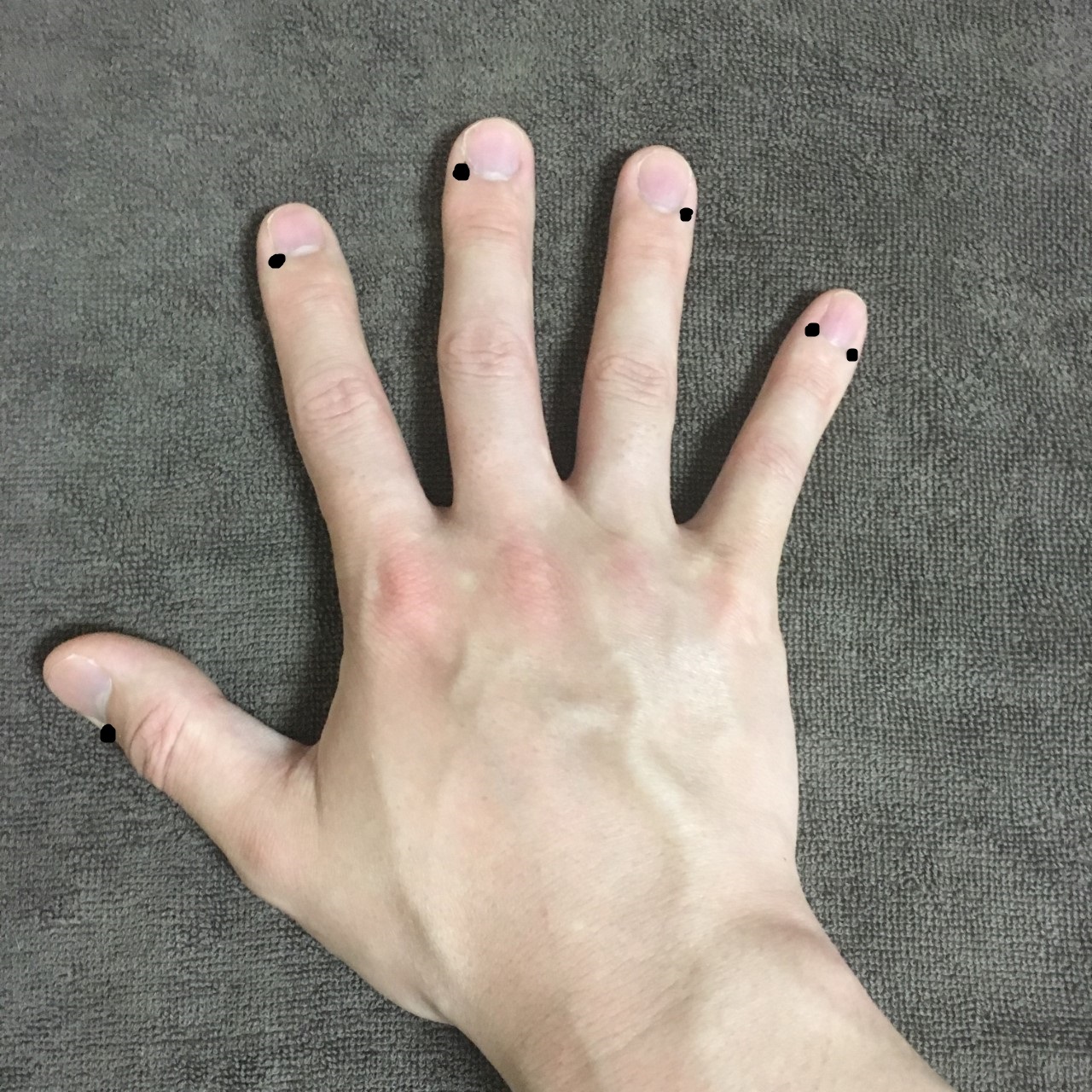 刺絡治療