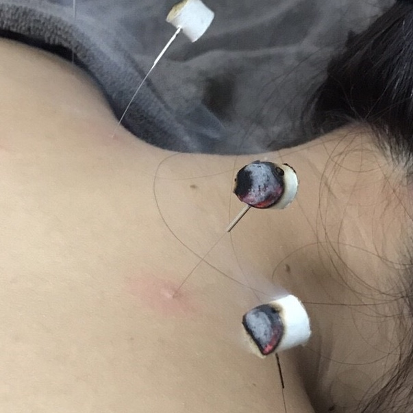 灸頭鍼治療