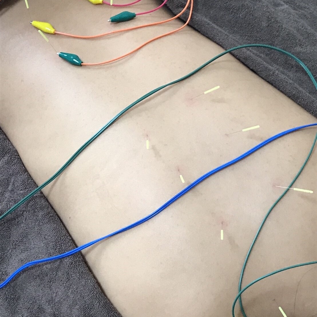 低周波鍼通電治療