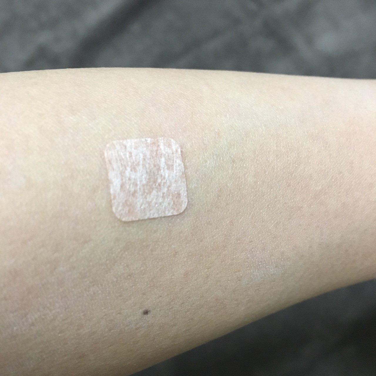 置き鍼治療