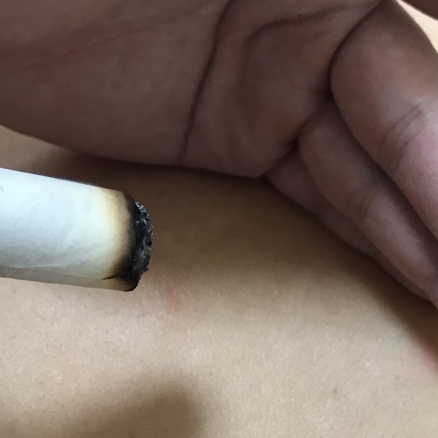 棒灸治療