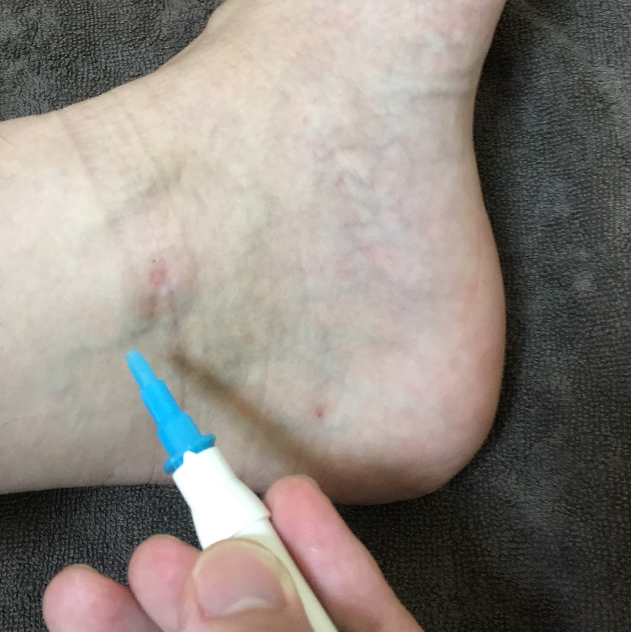刺絡治療