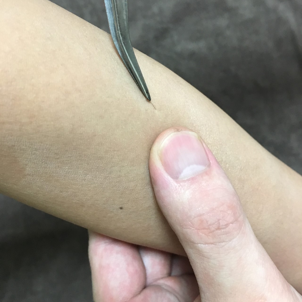 置き鍼治療