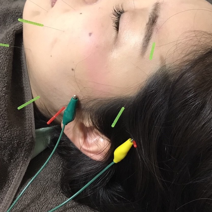顔鍼治療