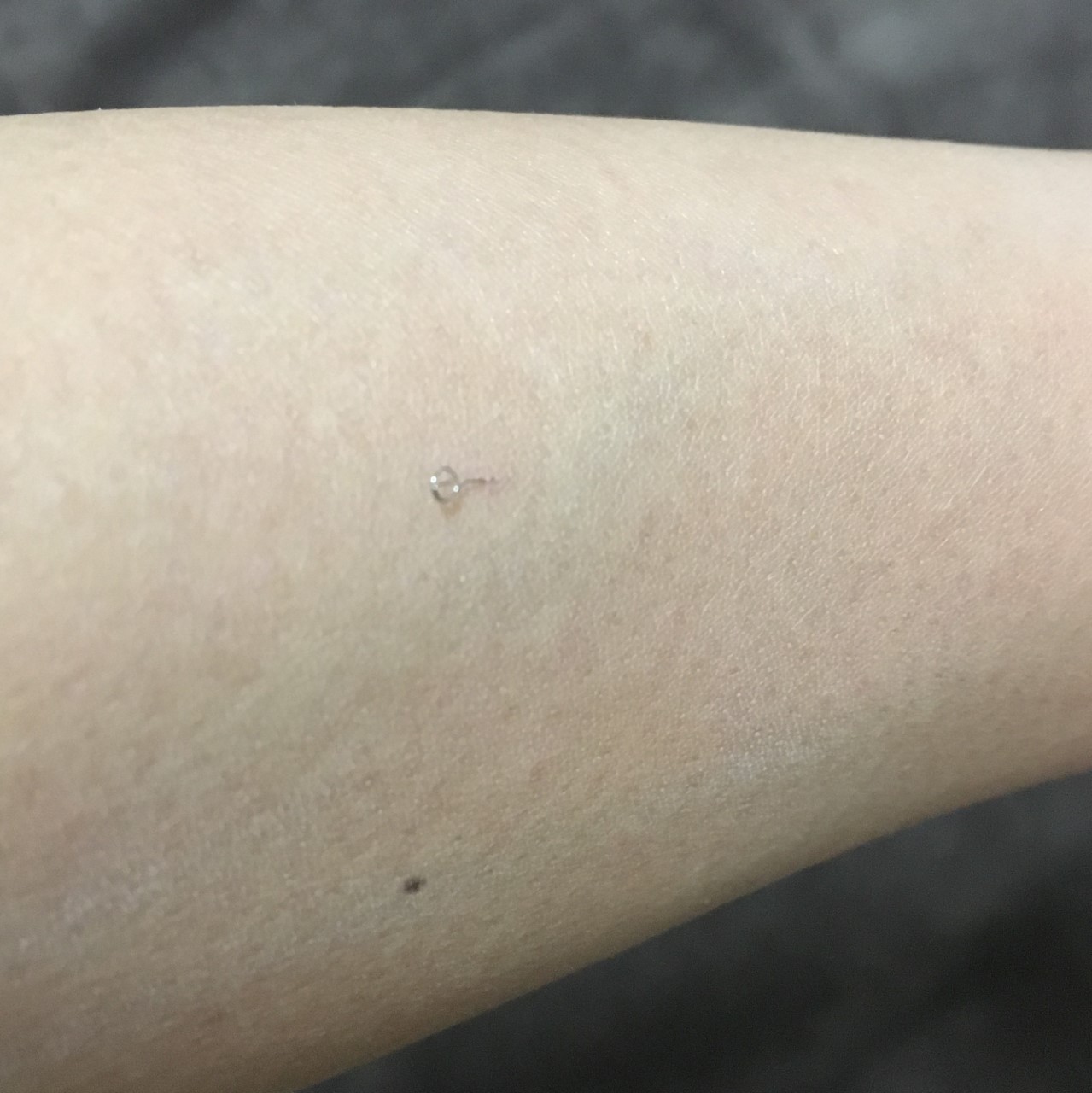 置き鍼治療