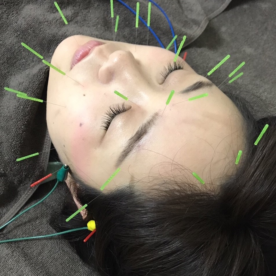 顔鍼治療