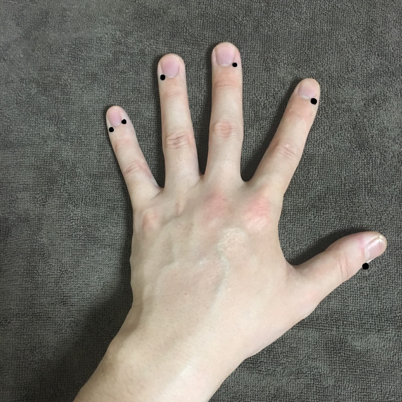 刺絡治療