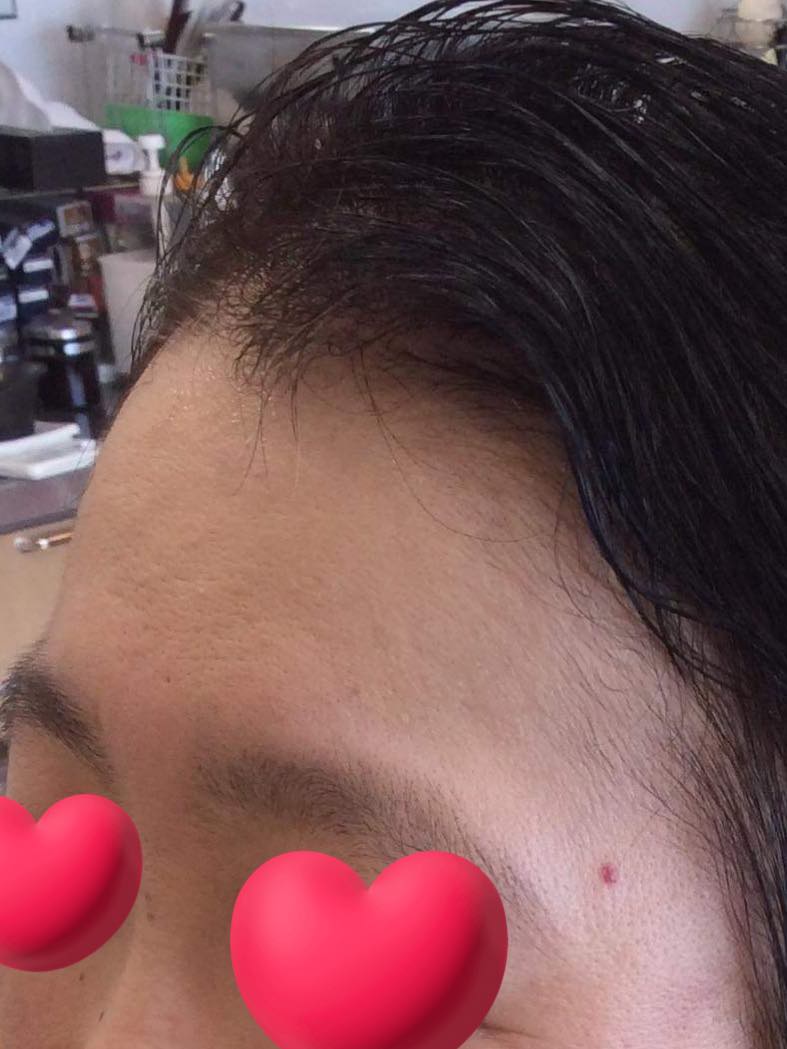 抗ガン剤治療後の前髪に悩む方へ