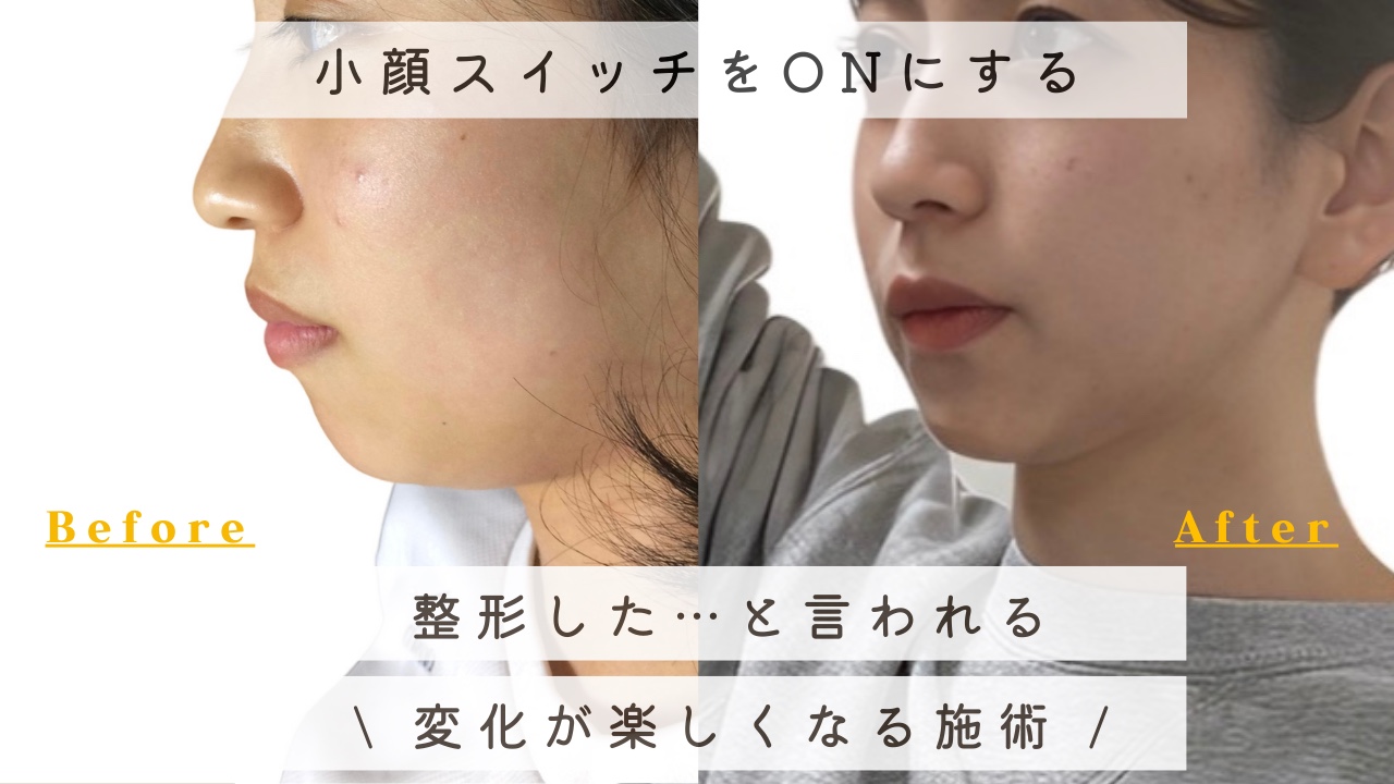 ハイエンド小顔イメージ
