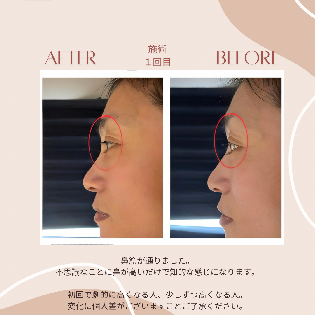 鼻筋の変化実例 前