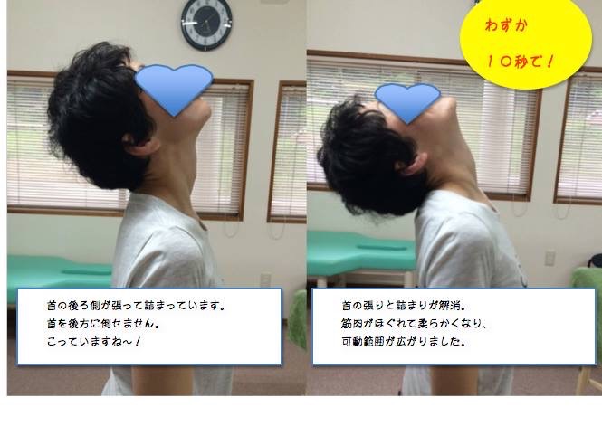 首の施術 ビフォーアフター