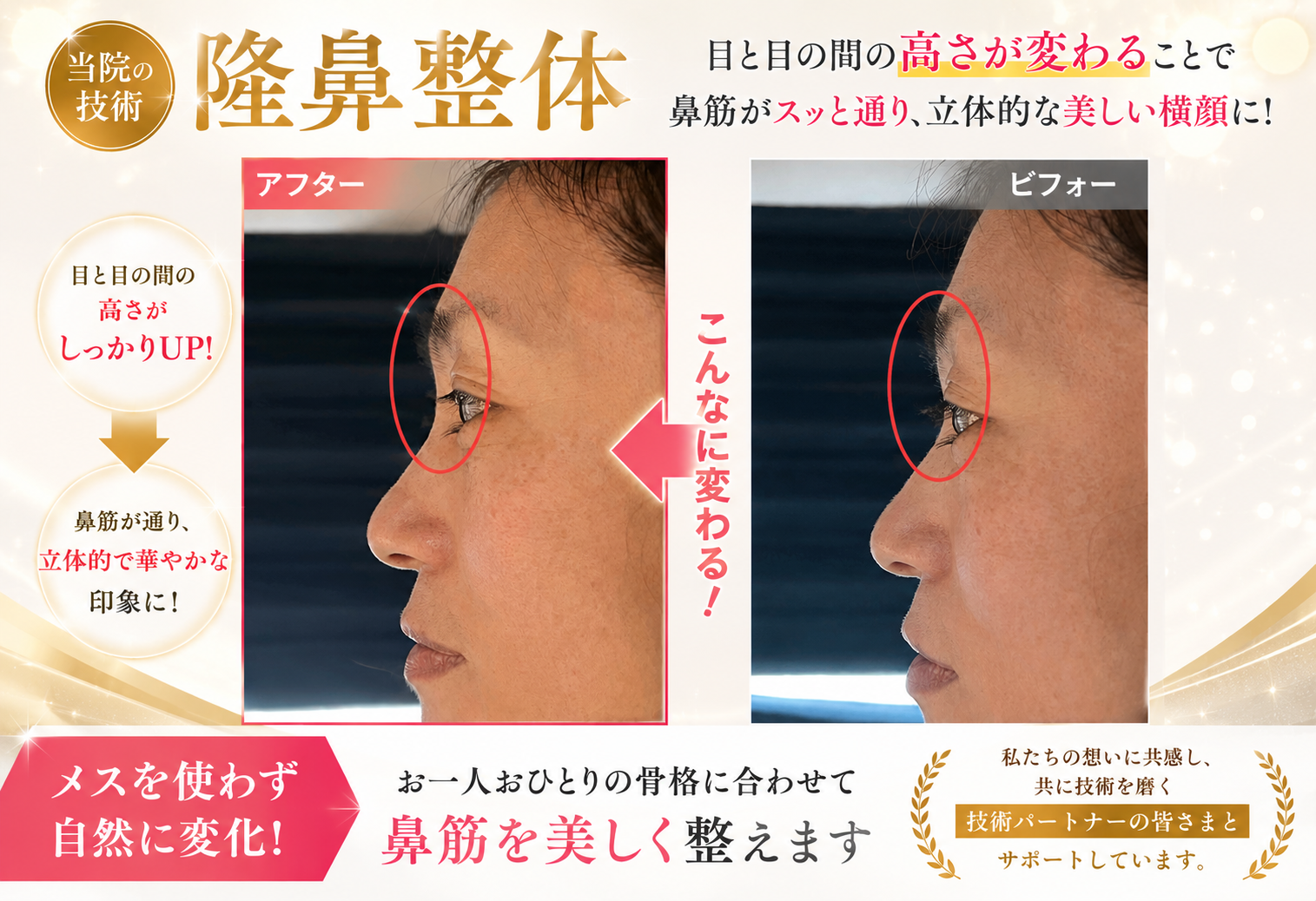 鼻筋の変化実例 前
