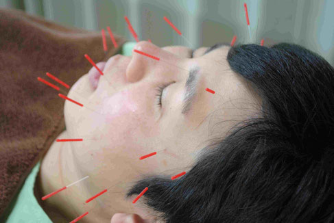 頭痛・こめかみの痛みに顔鍼｜顔まわりの筋肉と鍼灸治療