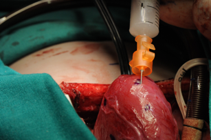 Terapia celular intramiocardica