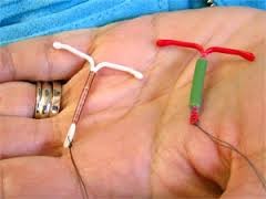 2 tipi di IUD