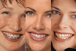 verschiedene Zahnspangen im Vergleich