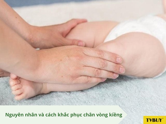Cách khắc phục chân vòng kiềng?