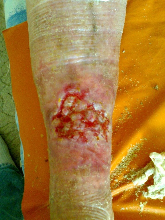посттромбофлебитический синдром трофическая язва приживление пересаженной кожи