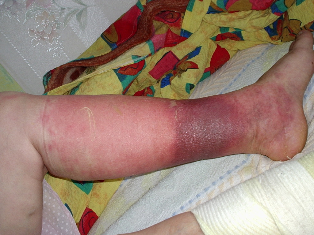 Как Выглядит Рожистое Воспаление На Ноге Фото