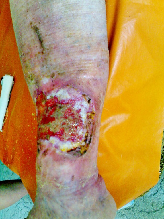 посттромбофлебитический синдром трофическая язва очищение раны