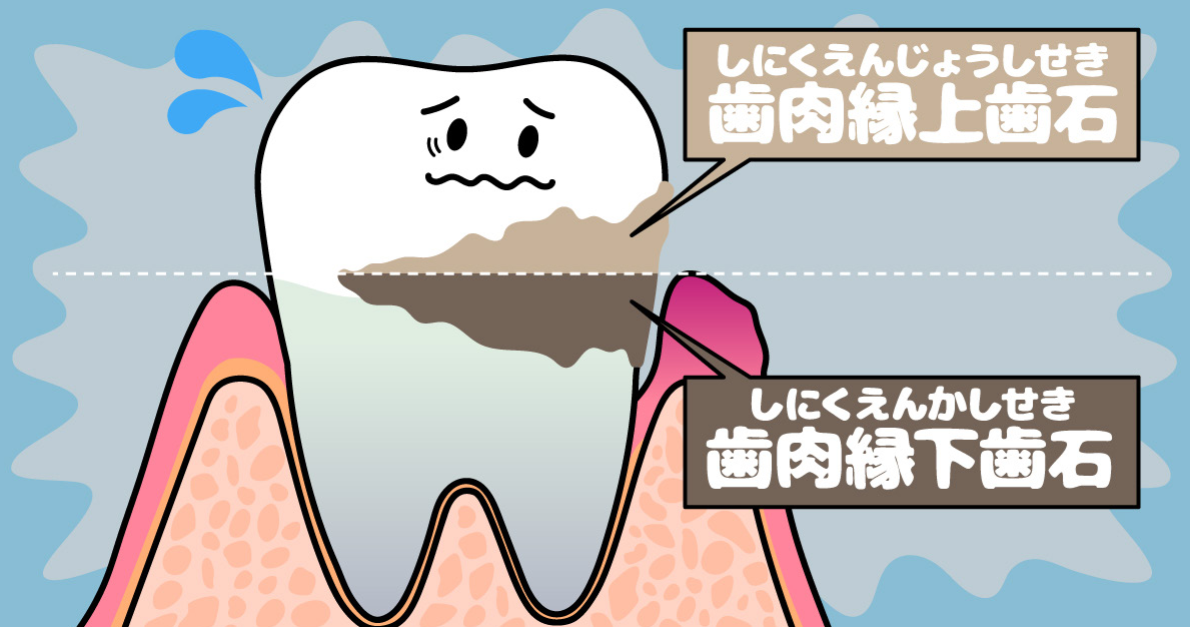 気になる歯石、自分でとっても大丈夫？