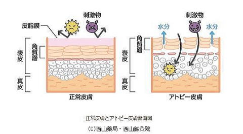 正常皮膚とアトピー皮膚の断面図（by新潟市の漢方薬専門店「西山薬局」）