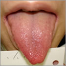 舌診：血虚体質