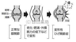 関節痛・関節炎のイメージイラスト（by新潟市の漢方薬専門店「西山薬局」）