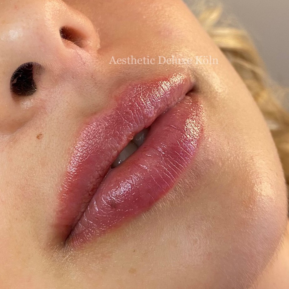vorher-nachher Lippenaufspritzen mit Hyaluron Aesthetic Deluxe Köln Russianlips Hyaluronbehandlung Köln Bonn Düsseldorf Lippenkorrektur