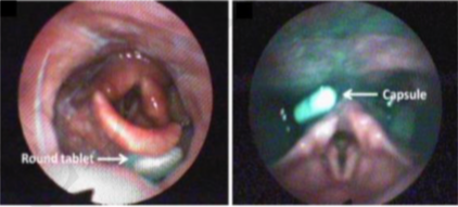 photos of round tablets and capsules in the oral cavity
